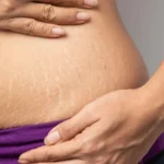 Penyebab Stretch Marks Muncul di Kulit.