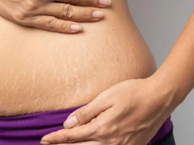 Penyebab Stretch Marks Muncul di Kulit.