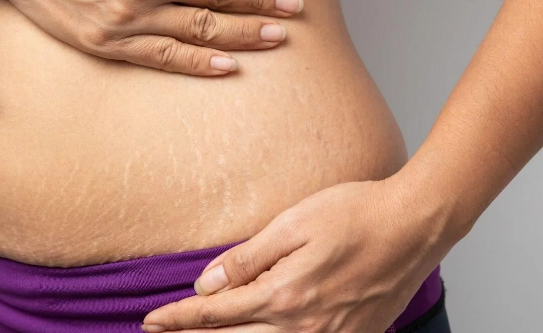 Penyebab Stretch Marks Muncul di Kulit.